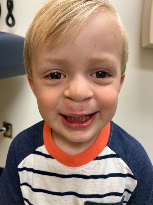 A boy after treatment for cleft lip